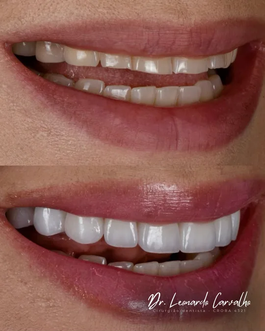 Registro do sorriso antes do tratamento na imagem superior e após o tratamento na imagem inferior.