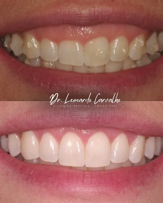 Registro do sorriso antes do tratamento na imagem superior e após o tratamento na imagem inferior.