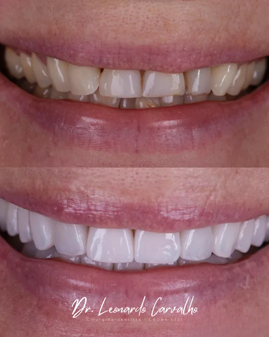 Registro do sorriso antes do tratamento acima e após o tratamento abaixo.