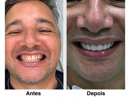 Comparativo do sorriso com o antes à esquerda e o depois à direita, conforme identificado na fotografia.