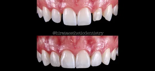 Dois registros dentais empilhados, com crédito a @hirataaestheticdentistry na imagem.