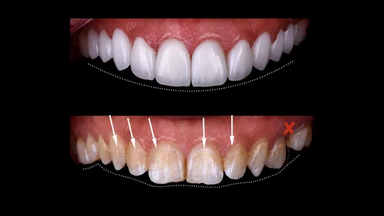Comparativo de duas vistas dos dentes, com linhas pontilhadas e setas na fotografia.