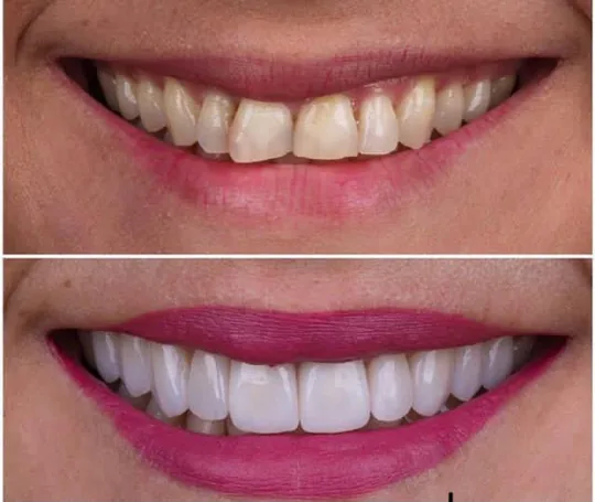Duas fotografias do sorriso, apresentadas uma acima da outra.